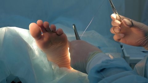 Surgeon sews wound on leg after surgery using self-absorbable threads, hands closeup. Doctor sutures ankle during surgery with neat stitches after removing hygroma. One day surgery concept.