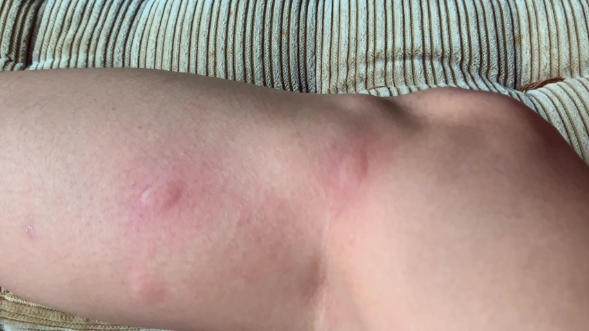 Young woman scratching many bites of insect, bed bugs, mosquito or flea on her leg. Health care, Beauty concept.