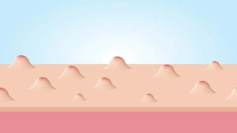 Acne and Pimples, stages of development, graphic animation