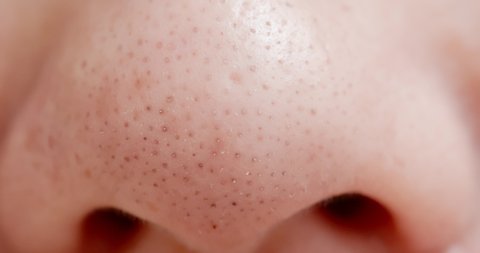 close up of blackheads on asian woman nose