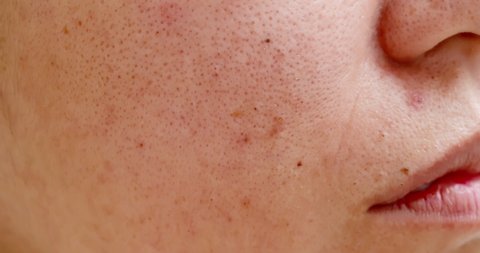 close up of acne on the woman face