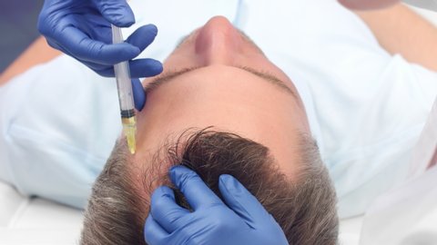 Close-up shot of male patient while the Platelet Rich Plasma treatment for hair restoration | PRP blood plasma injections for hair loss