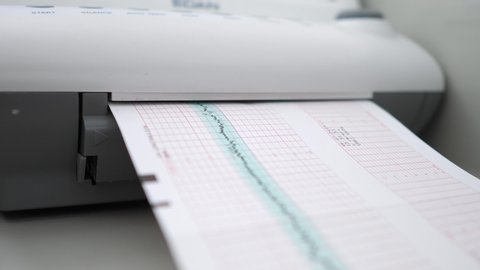 Close Up Of Fetal Heart Rate Monitor Printout
