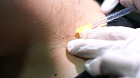 Close up video, Surgeon injecting local anesthetic around the mole before surgical birthmark removal.
