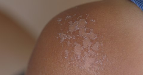 Sunburned skin, peeling skin from a sunburn