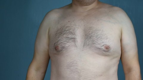 Gynecomastia, large breasts in men