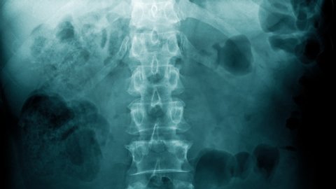 x-ray abdomen footage sliding up 