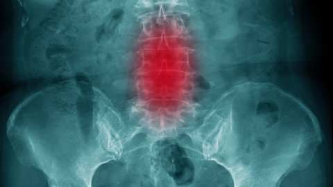 x-ray abdomen footage with red color hight light 