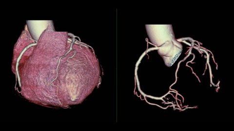 CTA Coronary artery 3D rendering image compare heart 3D and Coronary artery 3D turn around on the screen for diagnosis of vessel coronary artery stenosis .
