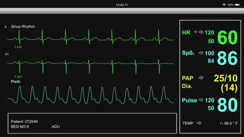Heart and patient monitor showing patient vital signs. Royalty-Free Stock Footage #1040937563