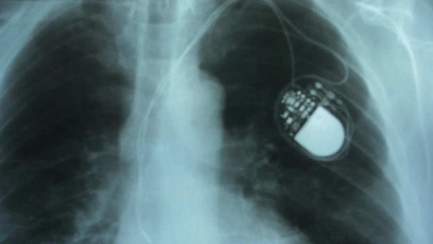 X-Ray Image of Chest with Artificial Cardiac Pacemaker Under Magnifying Glass Royalty-Free Stock Footage #1040972099