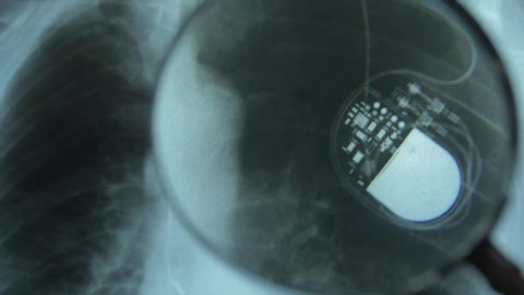 X-Ray Image of Chest with Artificial Cardiac Pacemaker Under Magnifying Glass