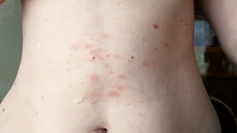 skin rash treatment on woman body. Shingles, Disease, Herpes zoster, varicella-z, lichenoid dermatitis