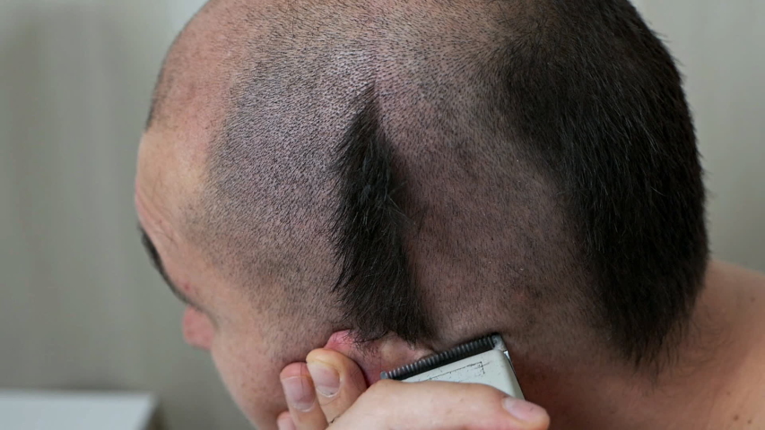Сон бритые головы. Бритье головы в нейрохирургии. Можно ли бритвой сбрить волосы на голове.