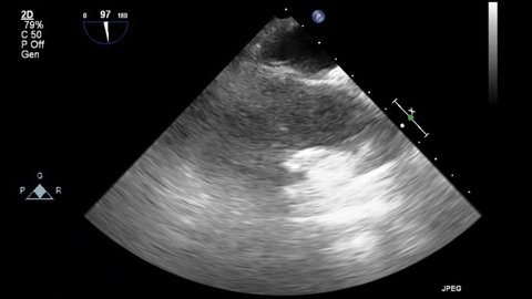 High-quality video ultrasound transesophageal examination of the heart.