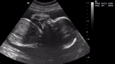 Ultrasound of pregnant woman in 6 month. Scientific analysis