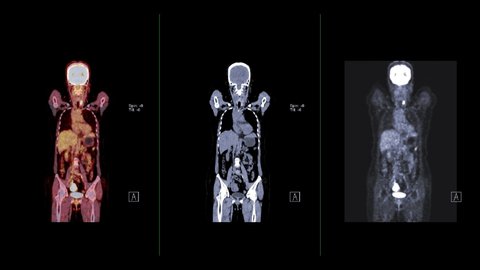 Compare CT Scan image and PET CT Scan fusion image of Whole human body coronal plane for detect cancer recurrence after surgery. 