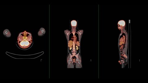 Compare of PET CT Scan fusion image of Whole human body axial , coronal and sagittal plane for detect cancer recurrence after surgery. 