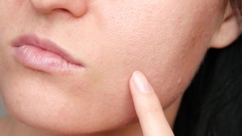 Skin texture with enlarged pores. Close-up of a woman's face.