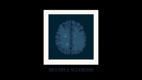 Multiple sclerosis motion graphics with MRI scan photo of brain affected by MS. Central nervous system disease. Demyelinating disorder awareness. Medical concept. Cartoon animation with alpha channel.