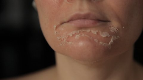 Retinoic face peeling. Woman's face after chemical peeling. Flaky skin on the face