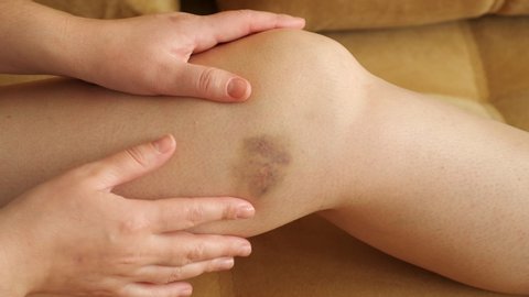 Woman examines and feels the bruise on her leg, close-up