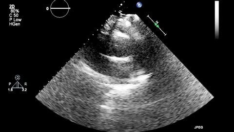 High quality transesophageal ultrasound video in gray-scale mode.