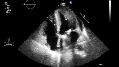 High quality transesophageal ultrasound video in gray-scale mode.