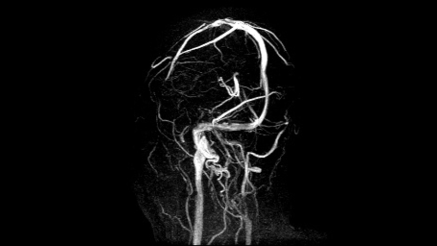 Cerebral angiogram of basilar artery for diagnosis abnormalities such ...