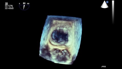 High quality transesophageal ultrasound video in 3D mode.