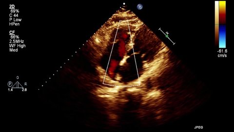 High quality transesophageal ultrasound video in Doppler mode.