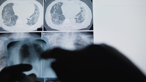 A lung x-ray passing in front of the camera. Concept of doctor examining lungs x-ray. Corona Virus Concept.