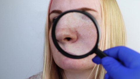 Expanded rosacea, pores, black spots, acne, close-up on the nose. A woman is being examined by a doctor. Dermatologist examines the skin through a magnifier, a magnifying glass 