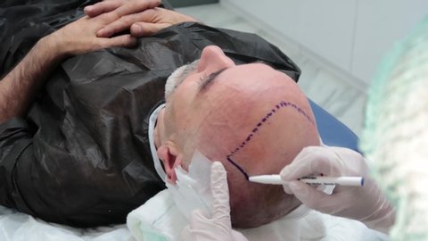 Hair Transplantation Operation - Hair Transplant Men Clinic