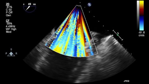 High quality transesophageal ultrasound video in Doppler mode.
