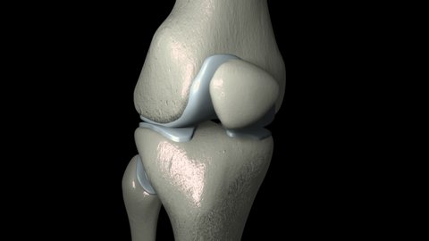 This video shows the knee osteoarthritis with osteophytes