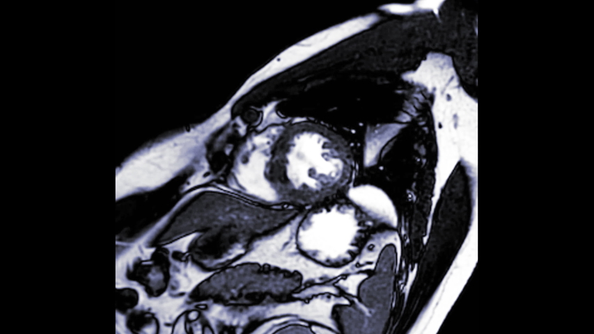 MRI heart or Cardiac MRI magnetic resonance imaging of heart in short axis view showing cross-sections of the left and right ventricle for detecting heart disease., a Healthcare Video by Radiological imaging