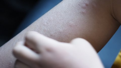Children with dermatitis, Asian boy scratching skin of itchy and red patches and nodules on arm.