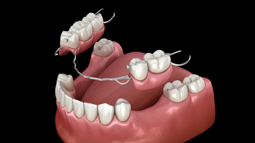 removable partial denture mandibular prosthesis medically Stock Footage ...