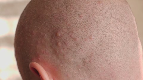 Close-up of a bald man's head with a rash on the skin from chickenpox. An adult male has varicella blister. Lots of red pimples on the skin. Slow motion.
