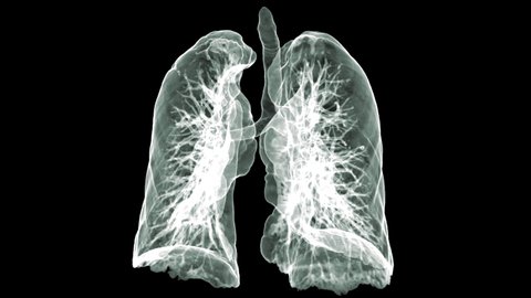 CT Lung 3D rendering image turn around on the screen for diagnostic  lung cancer .