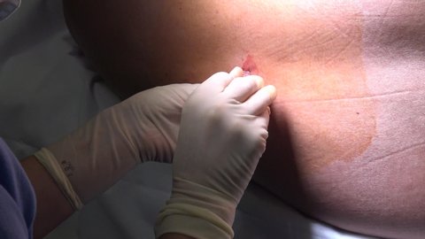 The doctor prepares the injection epidural