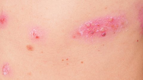 skin rash treatment on woman body. Shingles, Disease, Herpes zoster, varicella-z