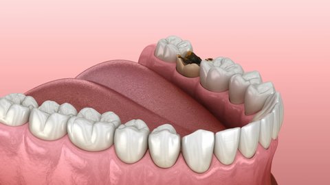 Periostitis tooth - Lump on Gum Above Tooth. Medically accurate dental 3D animation