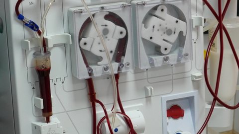 MOGILEV - PODILSKY, UKRAINE - JANUARY 16, 2020: Hemodialysis. The patient undergoes hemodialysis in the clinic.
