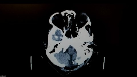 Brain CT Video with Cysticercosis - Larva of Pork Tapeworm