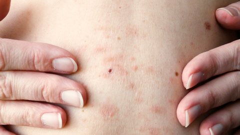 skin rash treatment on woman body. Shingles, Disease, Herpes zoster, varicella-z, lichenoid dermatitis	