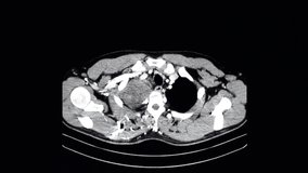 CT scan of a chest of patient showing large tumor in right chest cavity.  Animated or animation CT film. - Powered by Shutterstock - Get 15% off with code: PIKWIZARD15