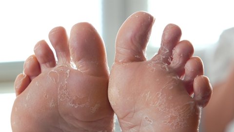 female feet with skin peeling after acid peeling procedure manipulations