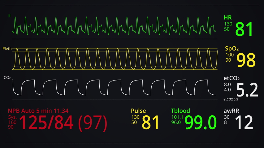 monitoring patient vital signs heart rate Stock Footage Video (100% ...